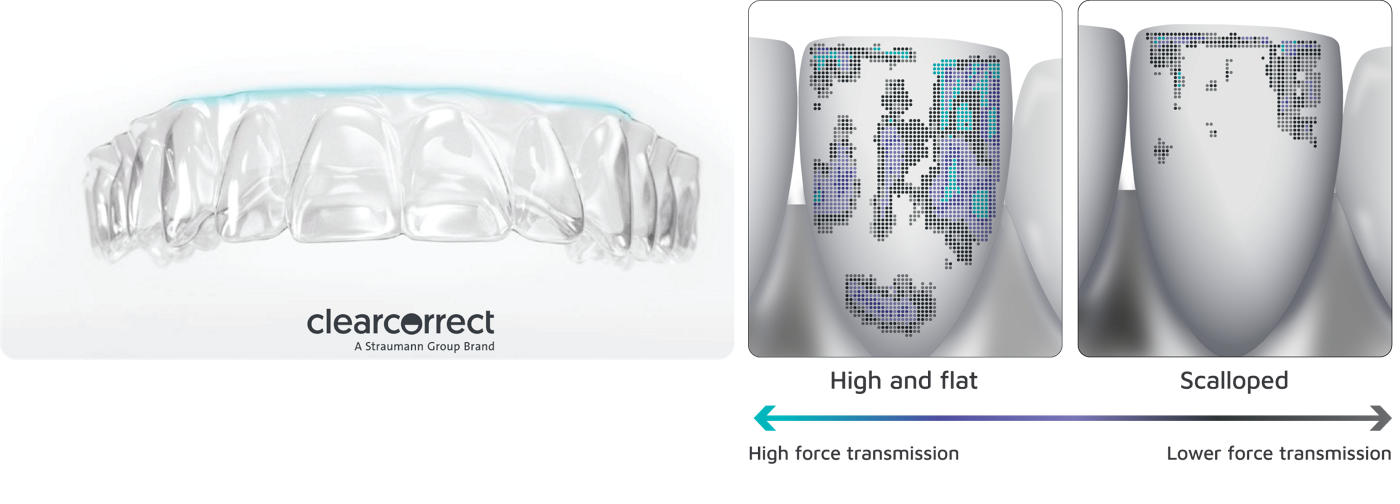 目立ちにくいマウスピース矯正(クリアコレクト)