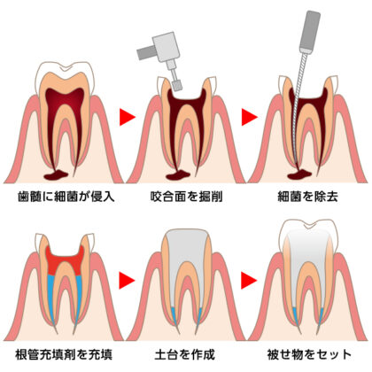 「根管治療」で歯を残せる場合があります！
