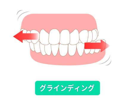 歯ぎしり・食いしばりとは？