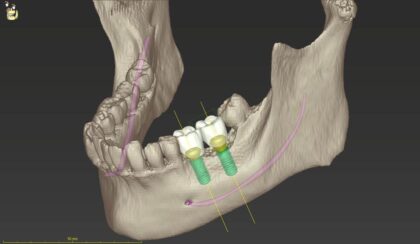 デジタルシュミレーションで精密かつ安全性を担保