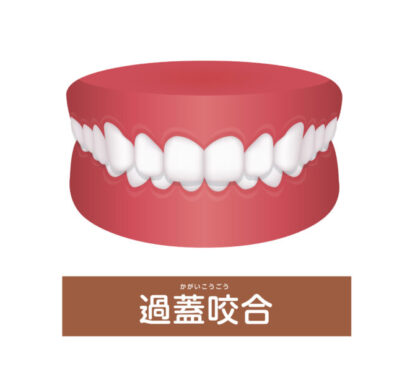 過蓋咬合