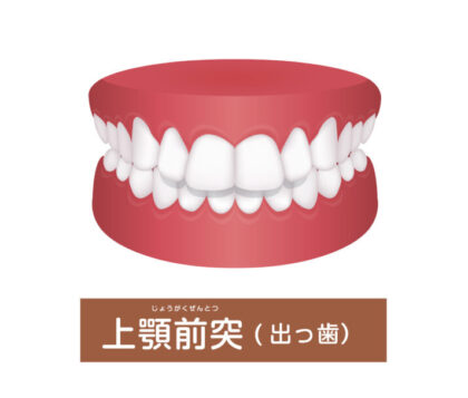 出っ歯