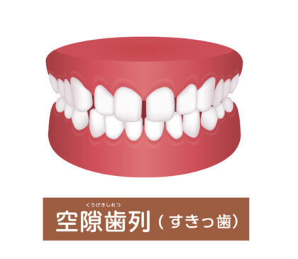 すきっ歯