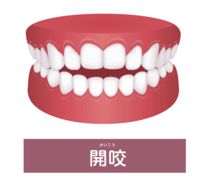 オープンバイト